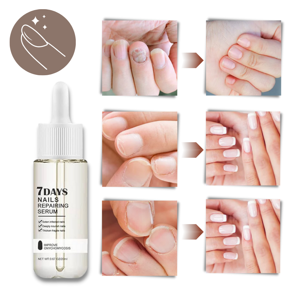 Kerena™ - Daily Nail Repair For Brittle, Splitting Nails