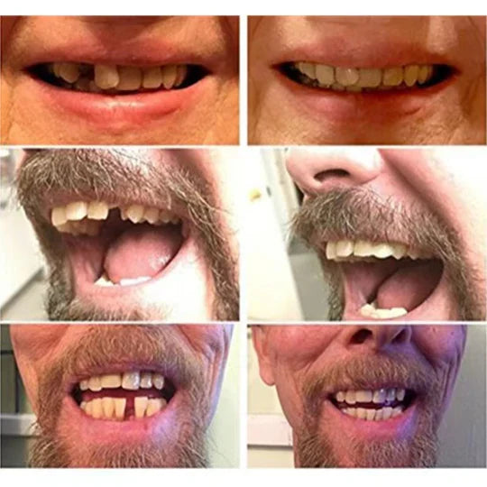 Smilix™ - Natural-Looking Temporary Veneers In Minutes