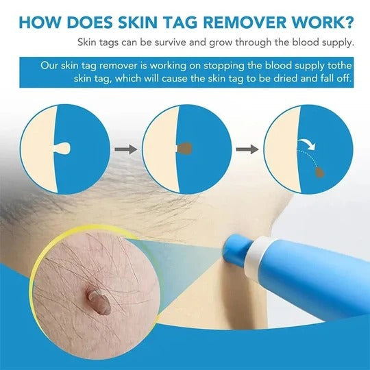 Cirra™ - Precise Placement for Small Raised Skin Areas