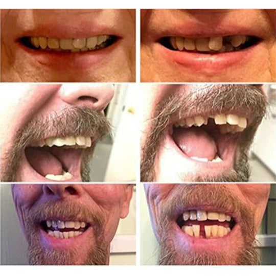 VeloDent™ - Natural-Looking Cosmetic Smile Cover for Occasional Wear